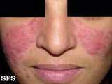 acne rosacea