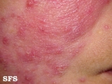 acne rosacea