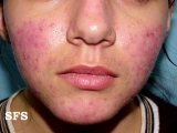 acne rosacea