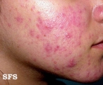 acne rosacea