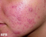 acne rosacea