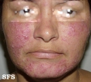 acne rosacea