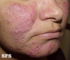 acne rosacea