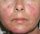 acne rosacea