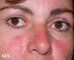 acne rosacea