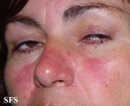 acne rosacea