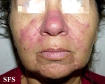 acne rosacea