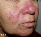 acne rosacea