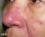 acne rosacea