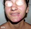 acne rosacea
