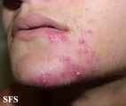 acne rosacea