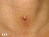 trichoadenoma