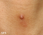 trichoadenoma