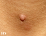 trichoadenoma