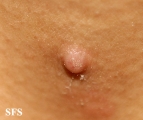 trichoadenoma