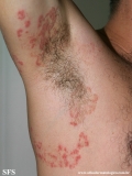 tinea corporis