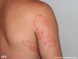 tinea corporis