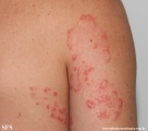 tinea corporis