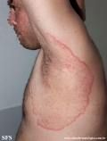 tinea corporis