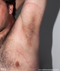 tinea corporis