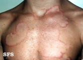 tinea corporis