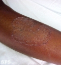 tinea corporis