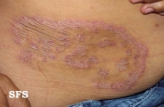 tinea corporis