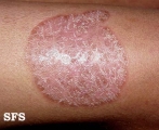 tinea corporis