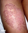 tinea corporis