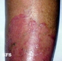 tinea corporis