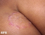 tinea corporis
