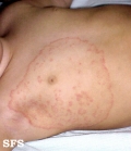 tinea corporis