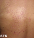 tinea corporis