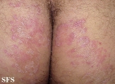 tinea corporis