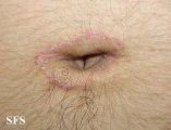 tinea corporis