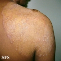 tinea corporis
