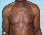 tinea corporis