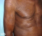 tinea corporis