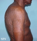 tinea corporis