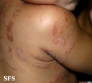 tinea corporis