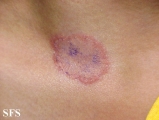 tinea corporis