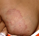 tinea corporis