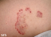 tinea corporis