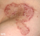 tinea corporis