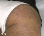 tinea corporis