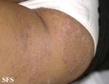 tinea corporis
