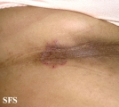 tinea corporis
