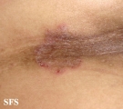 tinea corporis