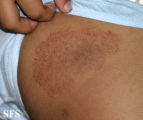 tinea corporis