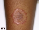 tinea corporis